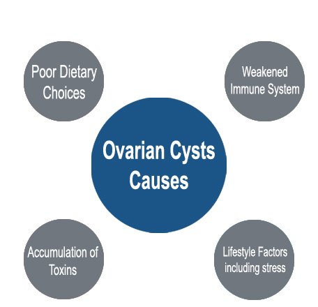 Ovarian Cysts Causes, Poor Dietary Choices, Weakened Immune System, Accumulation of Toxins, Lifestyle Factors including stress