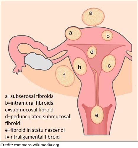 The One Fibroid Myth You Keep Falling For