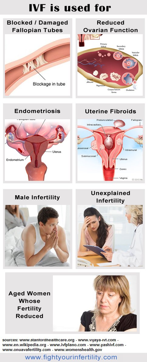 IVF is used for, ivf blocked tubes, ivf damaged fallopian tubes, ivf ovarian function, ivf endometriosis, ivf uterine fibroids, ivf male infertility, ivf unexplained infertility