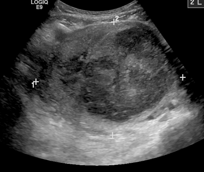 Large fibroid of the uterus which is causing pelvic congestion syndrome as seen on ultrasound