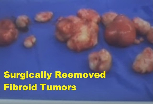 Surgicall Removed Fibroids Tumors