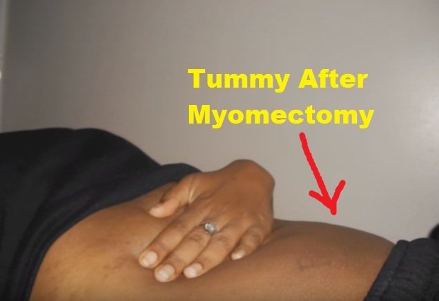 Tummy After Myomectomy
