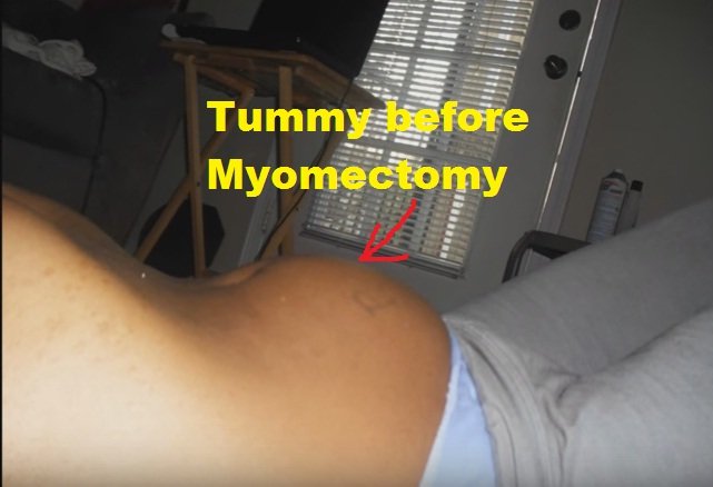 Tummy before Myomectomy