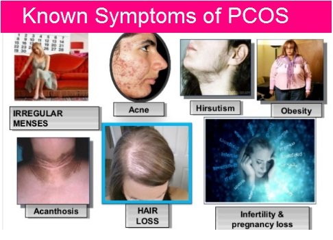 known-symptoms-of-pcos, PCOS symptoms, symptoms of PCOS