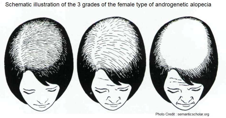 Schematic illustration of the 3 grades of the female type of androgenetic alopecia