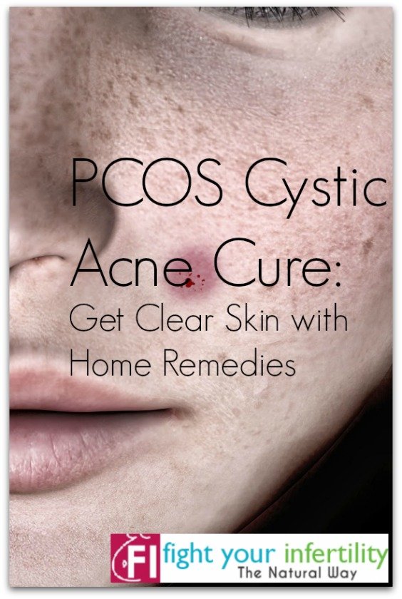 PCOS Cystic Acne Cure – Get Clear Skin with Home Remedies